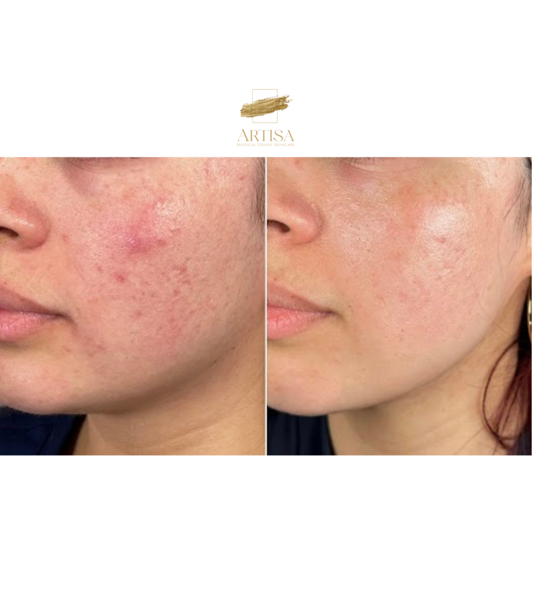 Before and after - Real Artisa Results