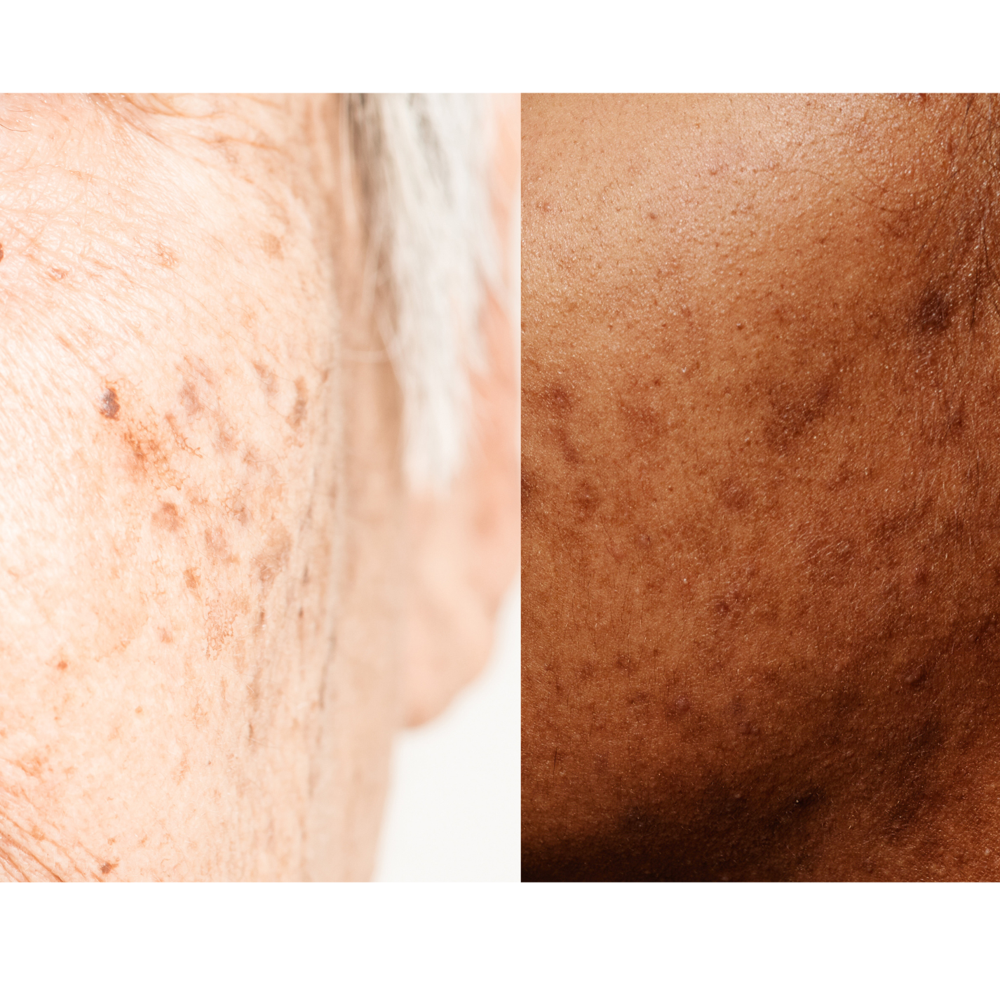 Why hyperpigmentation keeps coming back