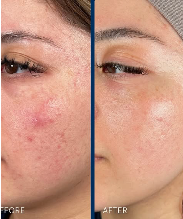 Before and after results - texture and redness improvement