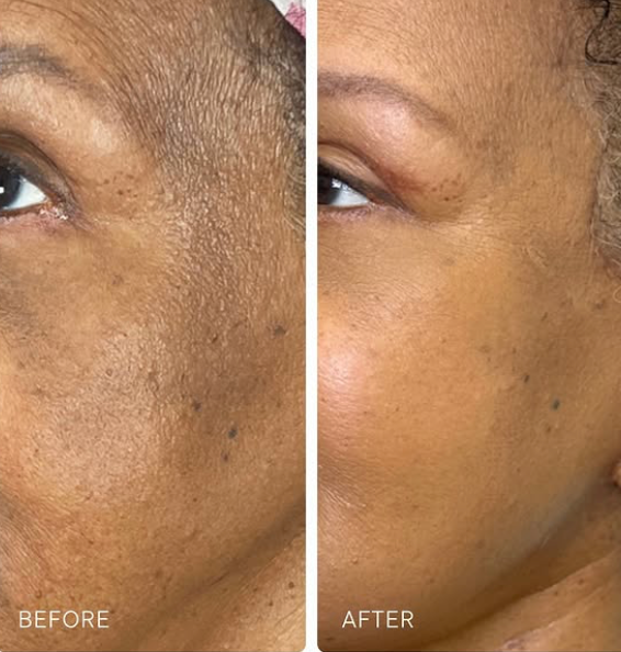 Before and after results - tone and texture improvement